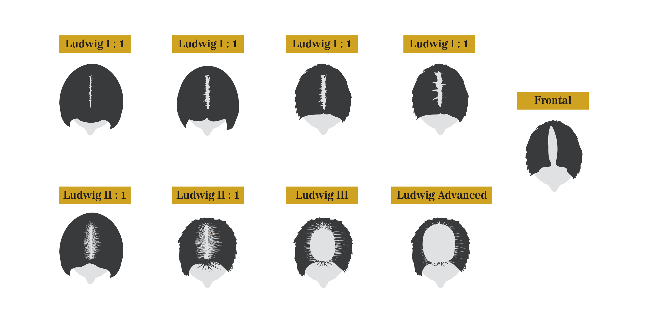 Pattern of Female Hair Loss