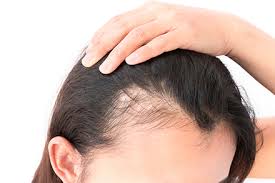 Female Hair Loss