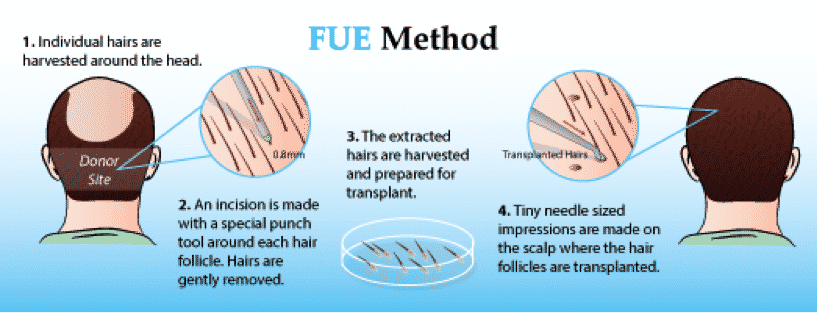 FUE or Strip Excision