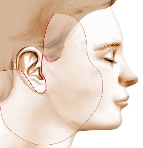 Corrective Surgery Of Sideburns