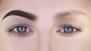 Corrective Surgery Of Eyebrows